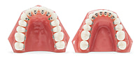 U Ortho Lingual Brackets 018 – STB, Silver & Golden Series