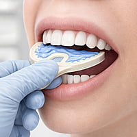 Oro Bite Registration & Impression Trays – Disposable Dental Trays