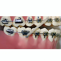 OrthoMetric Advanced Series Bondable Molar Tubes MBT022 (Pack of 10)