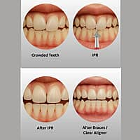 SuperEndo ProxiSure IPR Interproximal Reduction Bur Kit (Pack of 8 Burs)