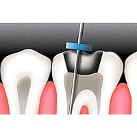 SuperEndo Silicon File Stoppers Pack of 100 – Endodontic File Stoppers