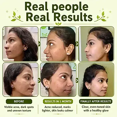 Tarunya Pitaka Pimple Mark gel
