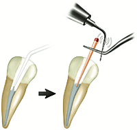 DiaDent Gutta Percha Non-Standardized – Endodontic Obturation Points