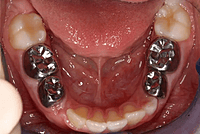 3M ESPE Stainless Steel Primary Crown E( 2nd Molar)