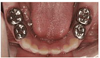 3M ESPE Stainless Steel Primary Crown E( 2nd Molar)