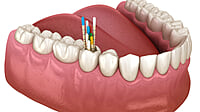 DiaDent Gutta Percha Non-Standardized – Endodontic Obturation Points