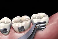OSL 1st Molar Weldable Buccal Tubes MBT 0.022 (Pack of 4)