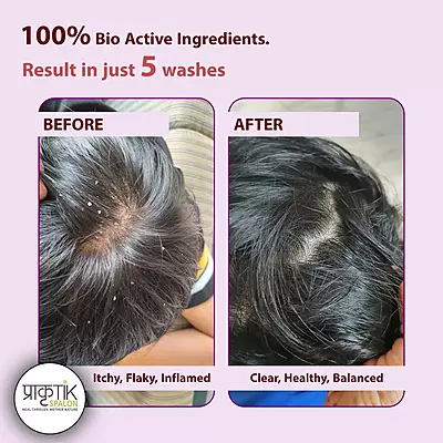 Jaswand Gel - Dandruff solution - 100gms