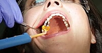ET Dental Intra Oral Tips – Disposable Dental Dispensing Tips