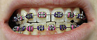 JJ Ortho Orthox Metal Bracket Kits – Orthodontic Brackets