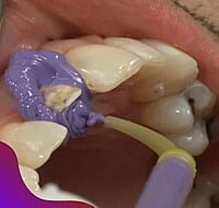 ET Dental Intra Oral Tips – Disposable Dental Dispensing Tips