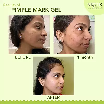 Tarunya Pitaka Pimple Mark gel