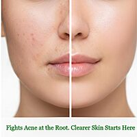 Harsha Naturals - Anti Acne soap-100