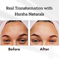 Harsha Naturals Anti Acne Face Cream - 50 gms