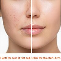 Harsha Naturals Anti Acne Face Pack 50 gms