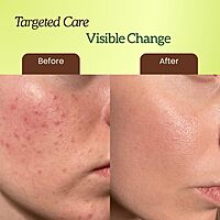 Harsha Naturals - Anti Acne Face Wash