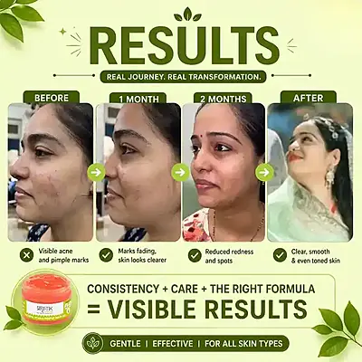 Tarunya Pitaka Pimple Mark gel
