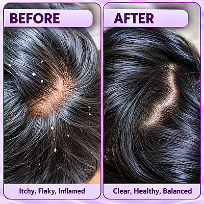 Jaswand Gel - Dandruff solution