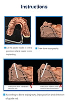 Cotisen Dental Implant Guide System Kit