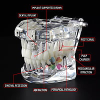 DENEXT Study Model