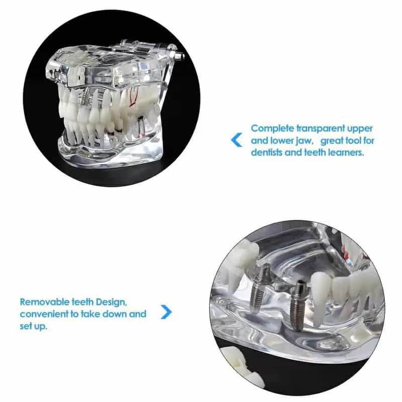 DENEXT Study Model