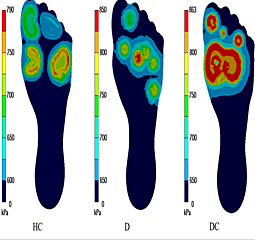 Diabetic Foot Pressure Mapping System