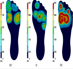 Diabetic Foot Pressure Mapping System