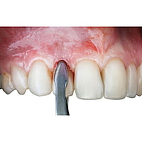 GDC Extraction Forceps Secure