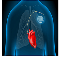 Pacemaker (Temporary & Permanent)