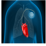 Pacemaker (Temporary & Permanent)