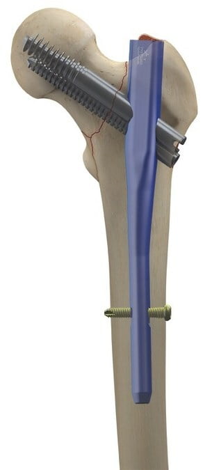 Long Proximal Femoral Integrated Screw Nail, 130°