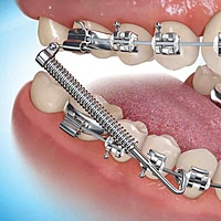 3M Unitek Gemini Metal Twin Brackets