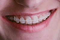 Phyx Nova Ceramic Brackets – MBT and Roth Orthodontic Brackets