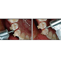 SuperEndo Interproximal Reduction Diamond Burs (Pack of 1)