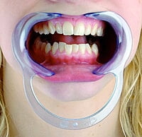 Cotisen Cheek Retractor – Flexible Autoclavable Dental Retractors