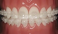 OrthoMetric New Iceram Ceramic Bracket Kit MBT 022 - (10.84.2000)