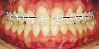 Phyx Nova Ceramic Brackets – MBT and Roth Orthodontic Brackets