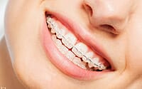 UU Ortho Mono Crystalline Sapphire Transparent Ceramic Brackets