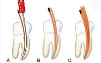 Dentsply ProTaper Universal Gutta Percha Points