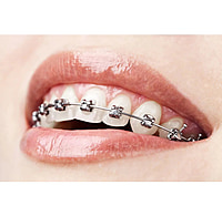U Ortho Self-Ligating Metal Brackets MBT 022