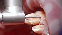 Prima Dental Diamond Bur Crown & Veneer Preparation Kit