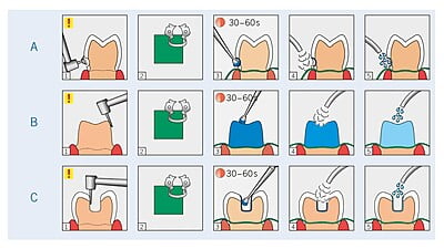 Kulzer Gluma Desensitizer Kulzer Gluma Desensitizer
