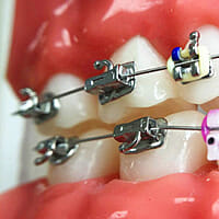 UU Ortho Bondable Buccal Tubes 1st Molar MBT 0.022