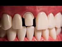 API Typodont Teeth Set with Screw