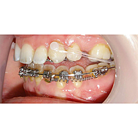 U Ortho Ceramic Lingual Buttons – Aesthetic Orthodontic Attachments