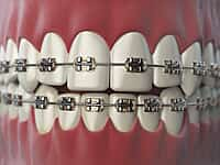 Ortho Organizer Metal Bracket Kit MBT 0.022 | Mini Twin Orthodontic