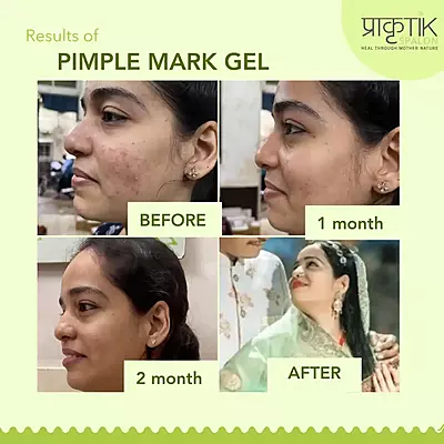 Tarunya Pitaka Pimple Mark gel