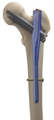 Short - Proximal Femoral Integrated Screw Nail (PFIN ) ,130