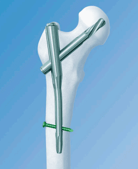 Long- Proximal Femoral Rotational Stability Nail (PFRN) , 130°