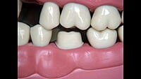 API Typodont Teeth Set of 24 with Screw – NZ (PEDO)